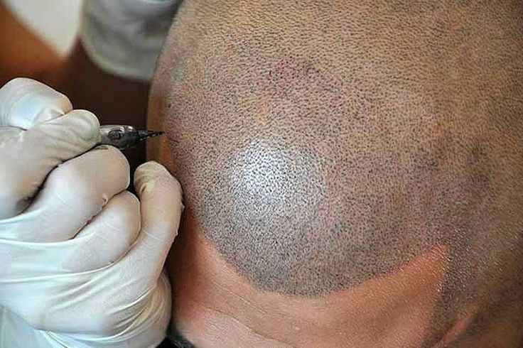 Hair Transplant in Riyadh: Donor Area Best Practices